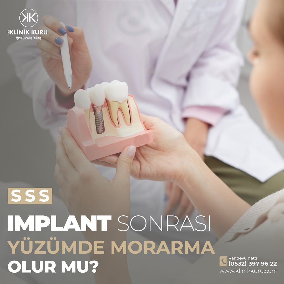 Implant sonrası yüzde morarma olur mu?